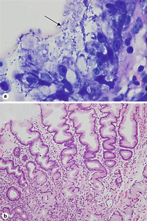 A Gastric Mucosal Biopsy Showing Numerous Hp Organisms Arrow On