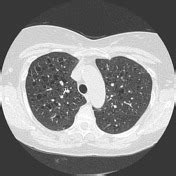 Pulmonary Langerhans Cell Histiocytosis Radiology Reference Article