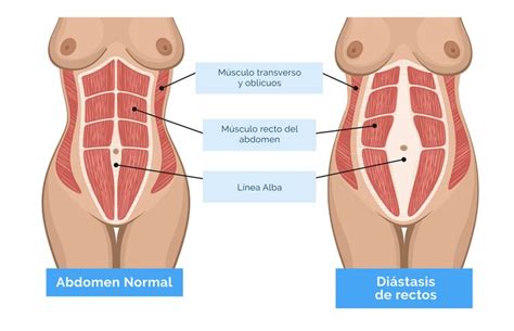 Cirug A De Di Stasis Abdominal Cirug A De Di Stasis De Rectos En