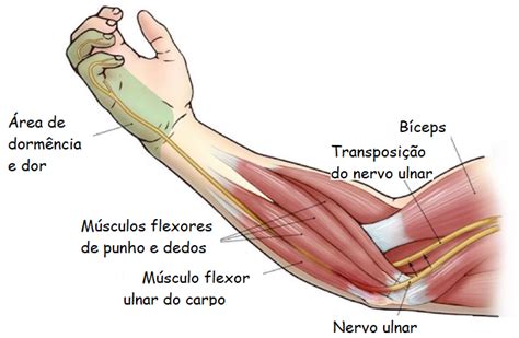 Compressão do nervo ulnar ou síndrome do túnel cubital