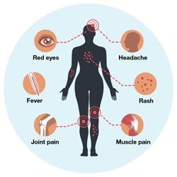 Symptoms | Zika virus | CDC