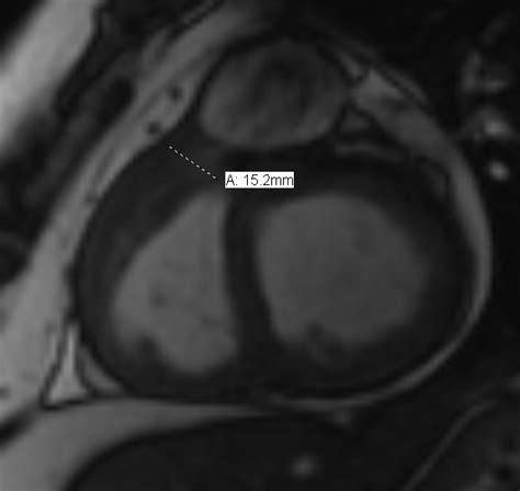 Incidental Infundibular Pulmonary Stenosis And Left Sided Superior Vena Cava Image