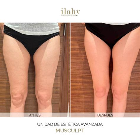 Celulitis En Las Piernas