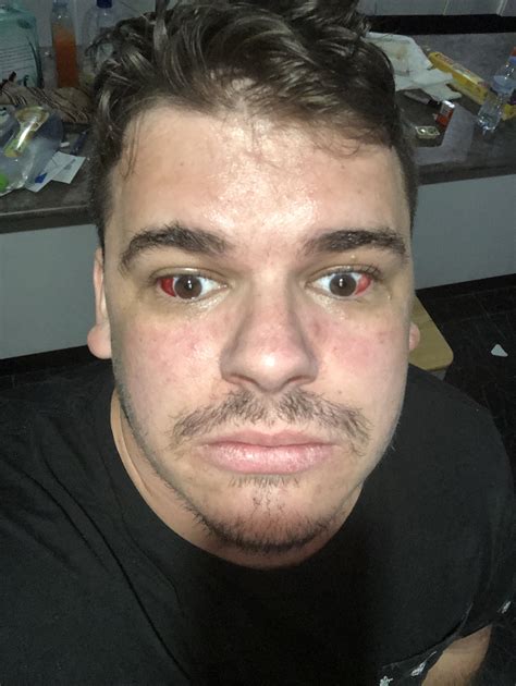 Post op laser eye surgery : r/WTF