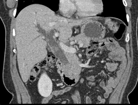 Common Bile Duct Stone Ultrasound