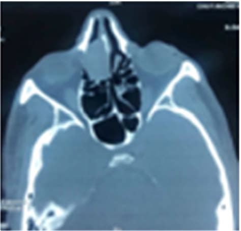 Ct Scan Axial View Showing A Homogeneous Mass Of 27 14 24 Mm