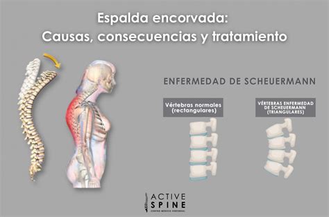 Espalda Encorvada Causas Consecuencias Y Tratamiento