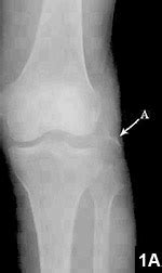 Isolated Avulsion Fracture of the Fibular Head: A New Fixation ...