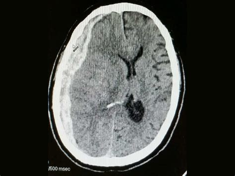 Image of the Week: Progressive headache, dizziness, and confusion in a