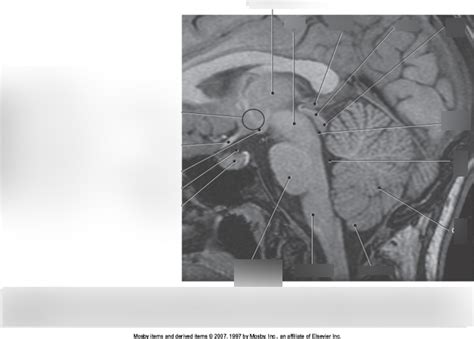 Sagittal T Mri Thalamus And Hypothalamus Diagram Quizlet