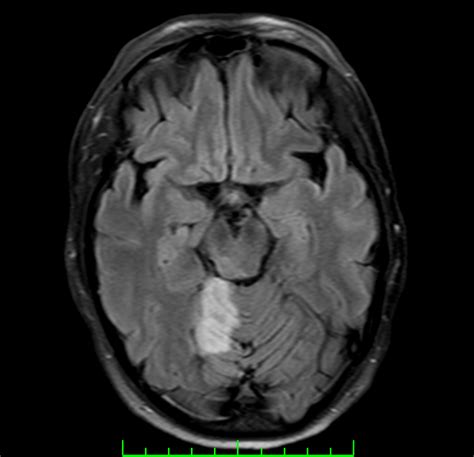 A Missed Stroke In A Young Healthy Man You First Neuro