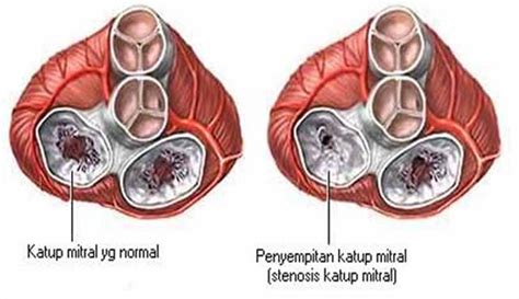 Gangguan Pada Jantung Serta Informasi Mengenainya Agmmedica