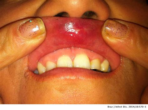 Gonorrhea On Lips Pictures | Lipstutorial.org