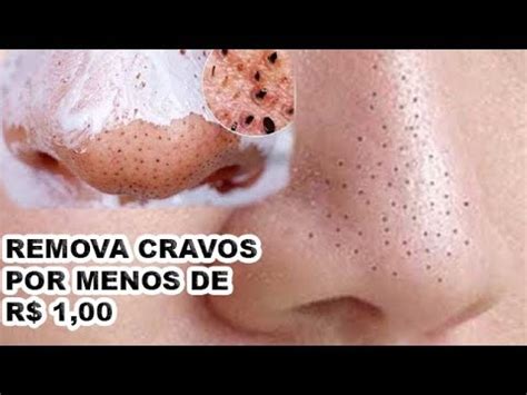 Como REMOVER CRAVOS Em 1 Minuto Por MENOS De R 1 00 REAL 100