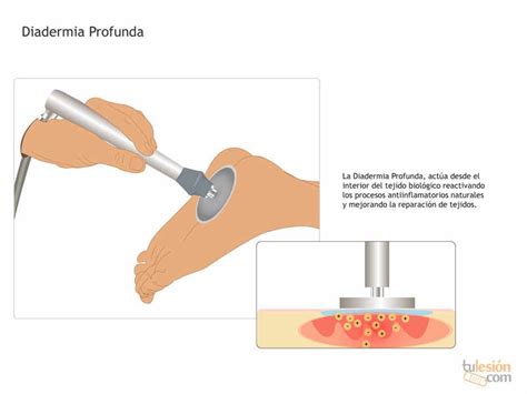 Diatermia O Tecarterapia En Fisioterapia Avanfi