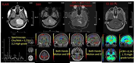 Comparison Of Low Grade And High Grade Glioma Normalized Blood Volume