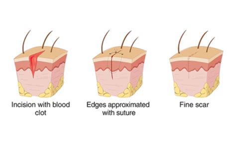 Wound Management Flashcards Quizlet