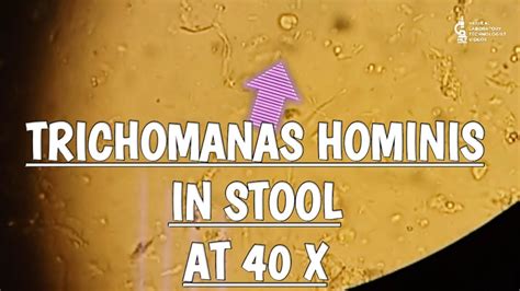 Trichomonas Hominis In Stool Microscopy At 40x Youtube