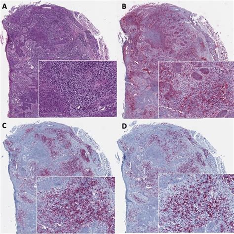 Morpheaform Basal Cell Carcinoma Mbcc A Microphotography Showing