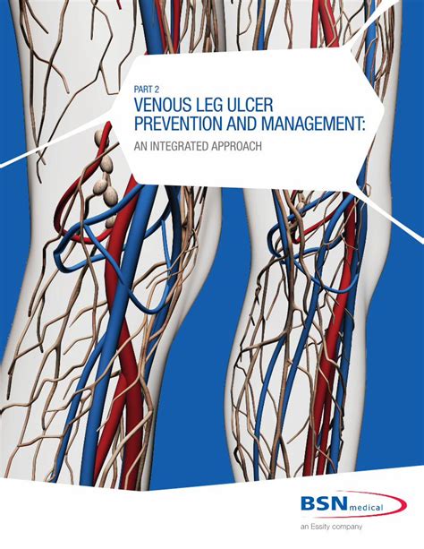 (PDF) PART 2 VENOUS LEG ULCER PREVENTION AND MANAGEMENT · VENOUS LEG ULCER PREVENTION AND ...