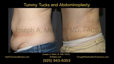 Abdominoplasty Tummy Tuck San Francisco Bay Area 19 Youtube