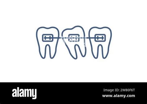 Correction Of Teeth With Orthodontic Braces Stages Of Teeth Alignment