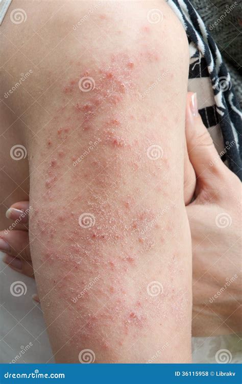 Allergic Rash Dermatitis Stock Photo Image Of Injury 36115958