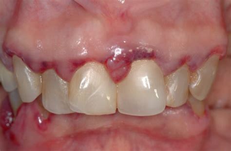 Leukemia Associated Gingival Overgrowth Leukemic Gingival Enlargement