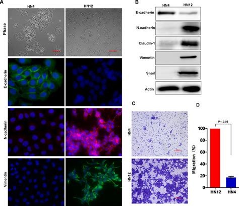 Lymph Node Metastatic Hnscc Cells Exhibit Emt Characters A