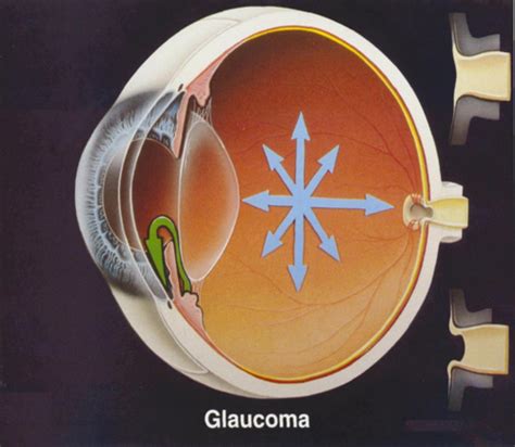 Glaucoma Flashcards Quizlet