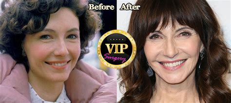 Mary Steenburgen Plastic Surgery | Surgery VIP