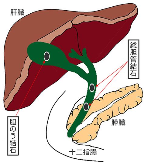 胆石症治療について｜医療法人慶仁会 城山病院