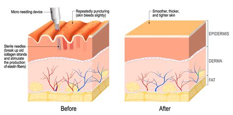 Dermapen Skin Needling Helps The Skin To Repair Itself Dermapen