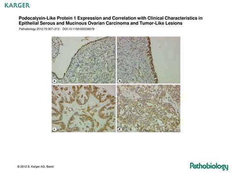 Podocalyxin Like Protein Expression And Correlation With Clinical