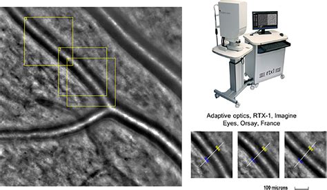 Prognostic Significance Of The Wall To Lumen Ratio Of Retinal