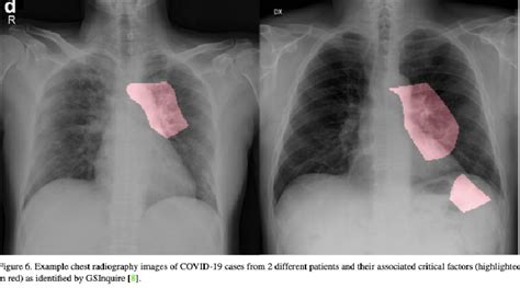 Covid This Ai Network Could Help Detect Cases Using Chest X Ray