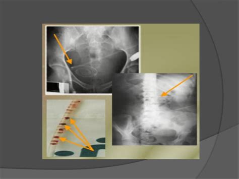 Complicaciones En Dialisis Peritoneal Ppt