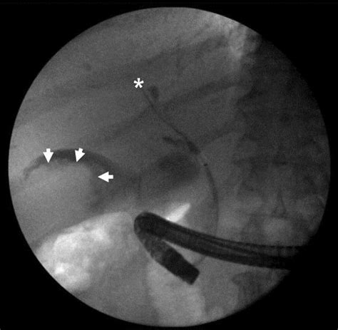 Occlusion Cholangiogram Obtained During Ercp Showing Adequate Filling Download Scientific