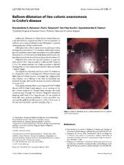 Balloon Dilatation Of Ileo Colonic Anastomosis In Crohn S Disease PDF