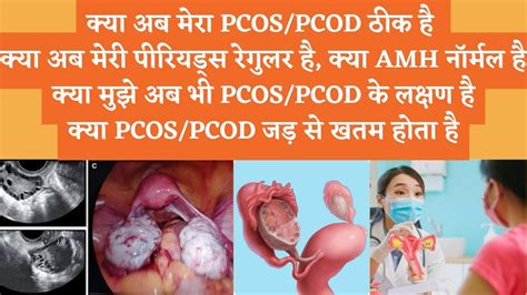 PCOS PCOD Update PCOS PCOD Story Kya Pcos Pcod Jad Se Khtam Hota