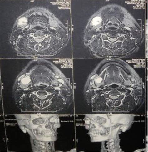 Figure 1 From PLEOMORPHIC ADENOMA OF SUBMANDIBULAR SALIVARY GLAND A