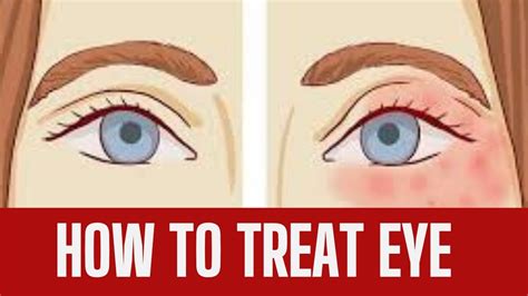 Eyelid Eczema Treatment Get Rid Of It Naturally Youtube