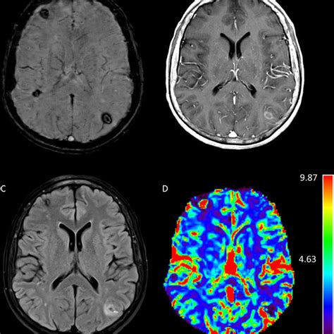 Magnetic Resonance Imaging Mri Of Brain With And Without Contrast At