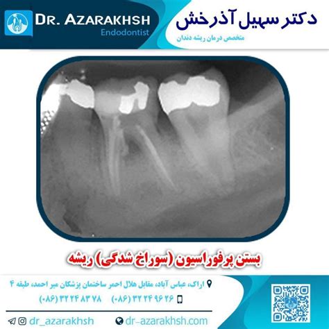 عکس عصب کشی دكتر سهیل آذرخش جراح و متخصص درمان ریشه دندان