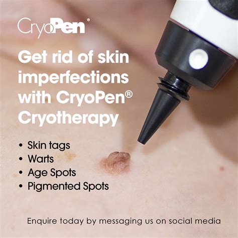 Removal Of Skin Imperfections With Cryopen Fountain Beauty