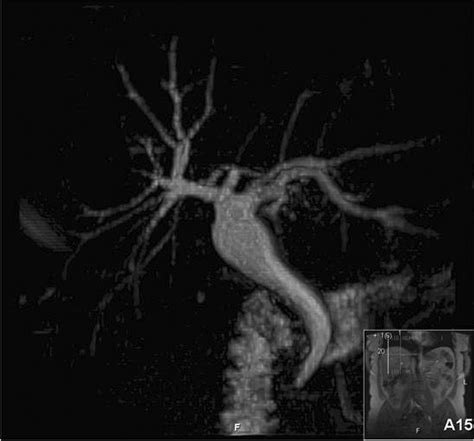 Gallbladder Agenesis With Choledochal Cyst—a Rare Association A Case Report And Review Of