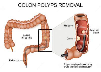 Colon Polyps Removal. Colonoscopy and Polypectomy Stock Vector - Illustration of tumor, anus ...