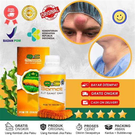 Jual Obat Benjolan Di Leher Kelenjar Getah Bening Lipoma Uci Uci