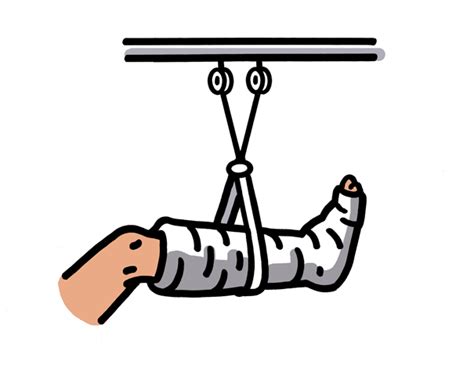 Bone Fracture Clipart - ClipArt Best