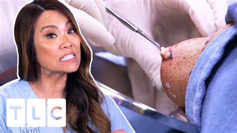 It Does Look Like Oatmeal Dr Pimple Popper Pop Ups Youtube